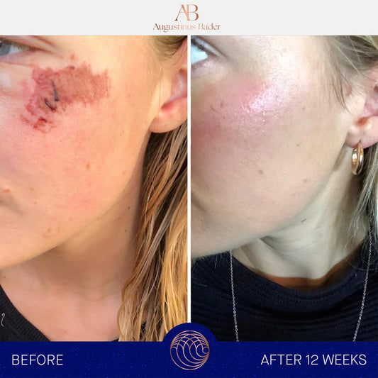 Before and after comparison of skin treatment on a person's face with Augustinus Bader branding.