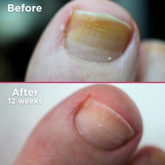 Footlogix Nail Tincture Spray 50 ml