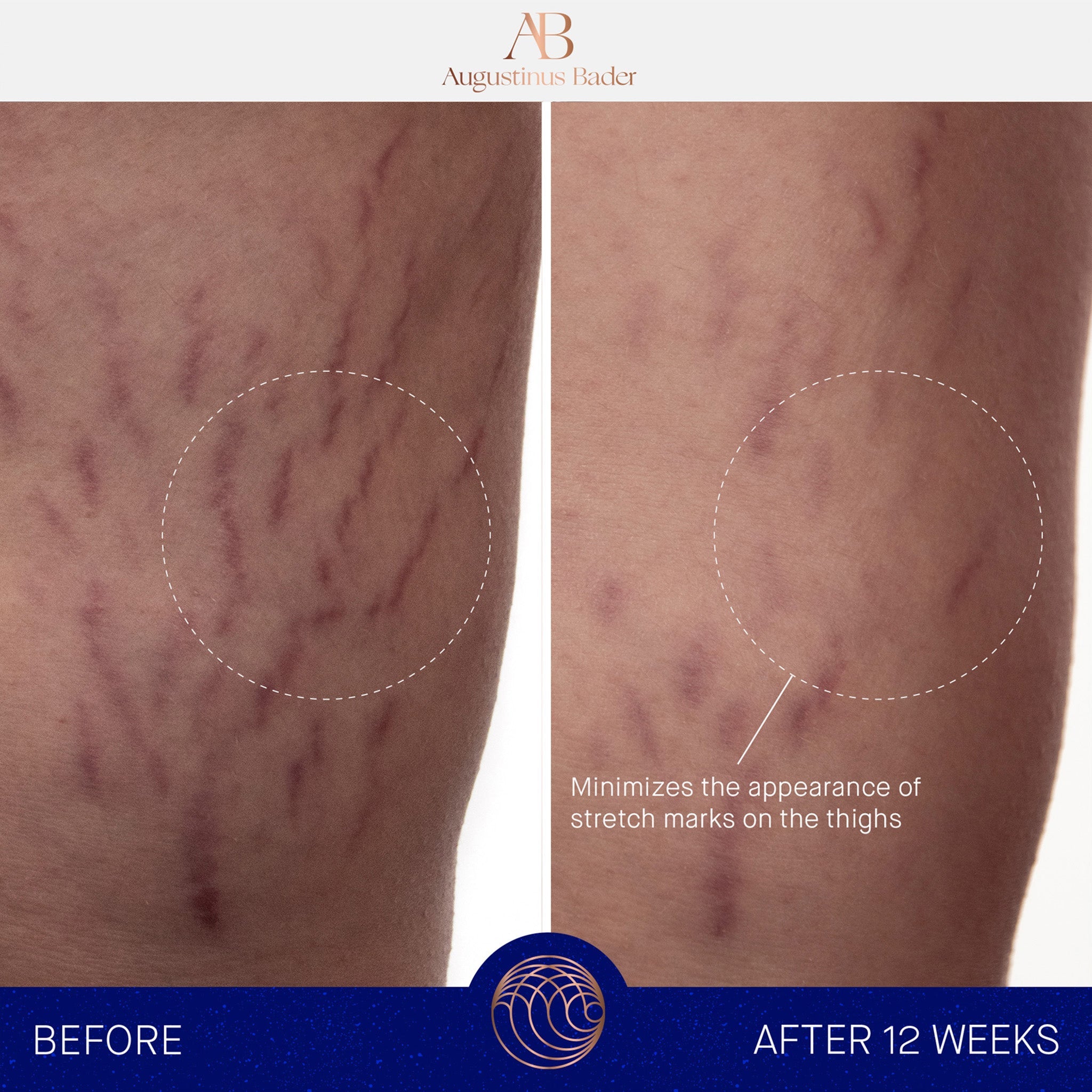 THE BODY CREAM FOR CELLULITE & STRETCH MARKS