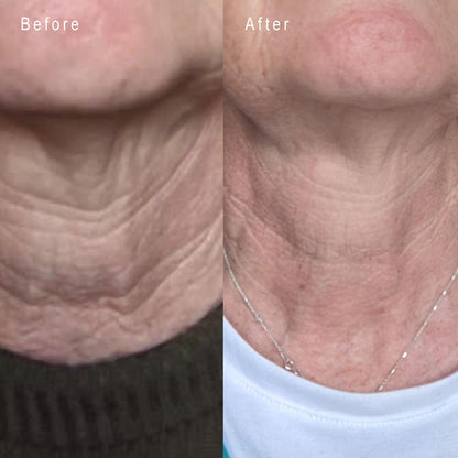 LYMA LASER OXYGEN MIST & GLIDE REFILL - 60 DAYS