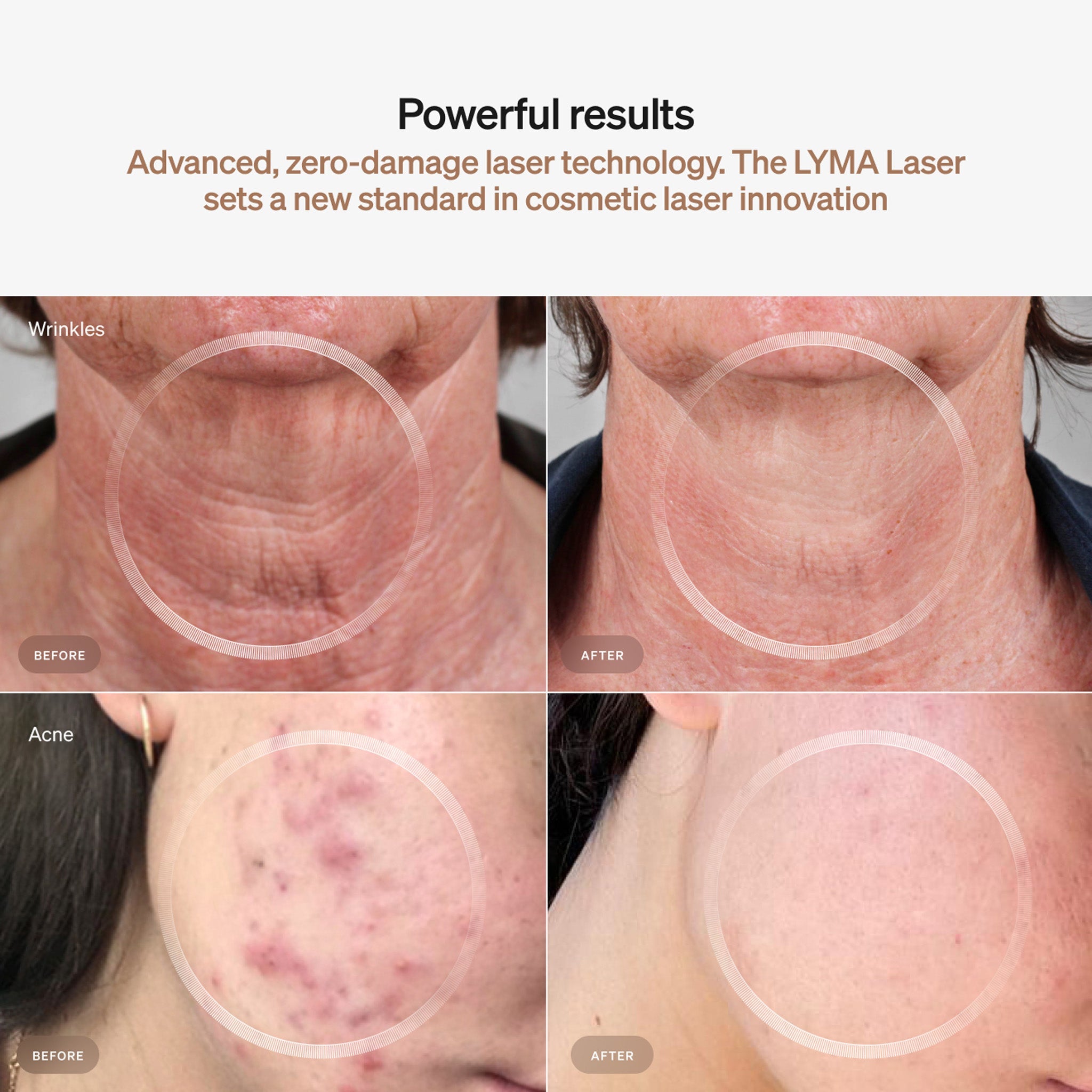 مجموعة LYMA LASER للمبتدئين