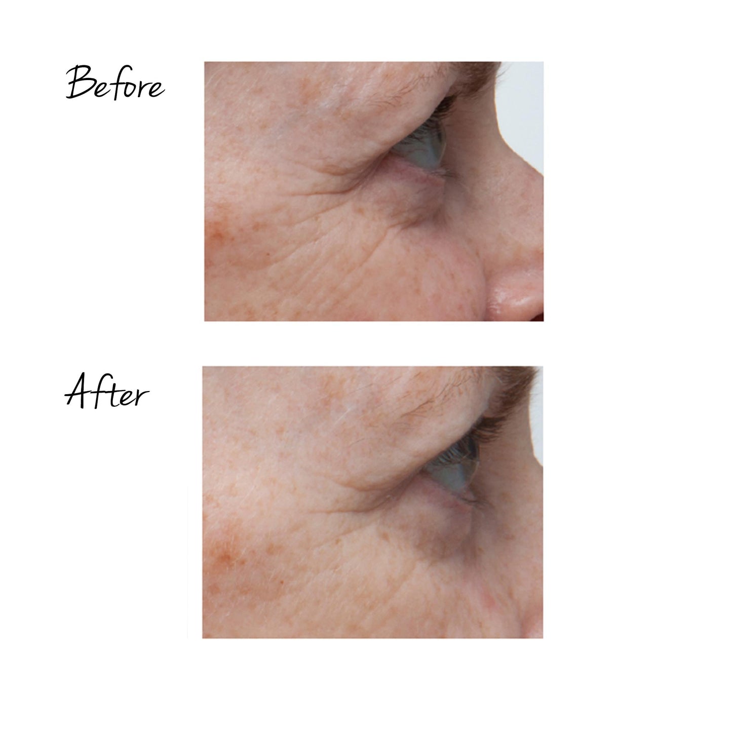 TRINITY WRINKLE REDUCER ATTACHMENT
