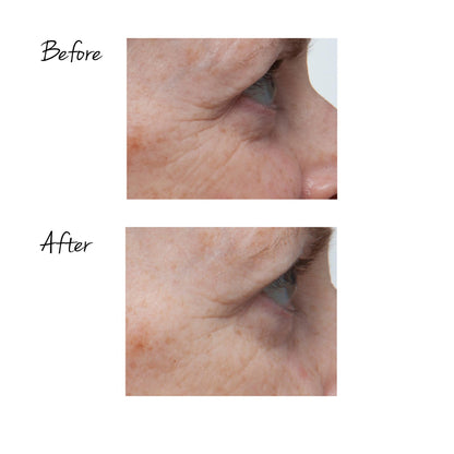 TRINITY WRINKLE REDUCER ATTACHMENT