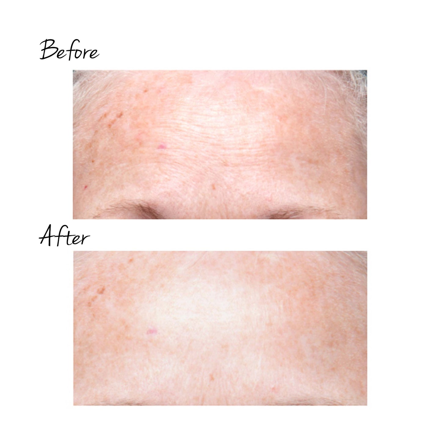 TRINITY WRINKLE REDUCER ATTACHMENT